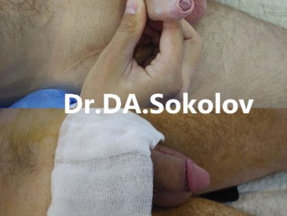 Обрезание полового члена для лечения приобретенного фимоза
